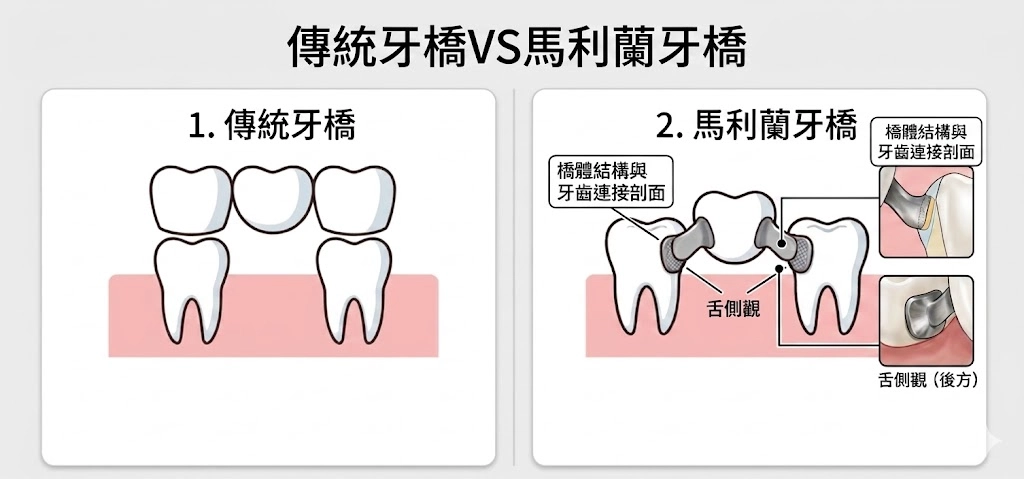 傳統牙橋、馬利蘭牙橋示意圖