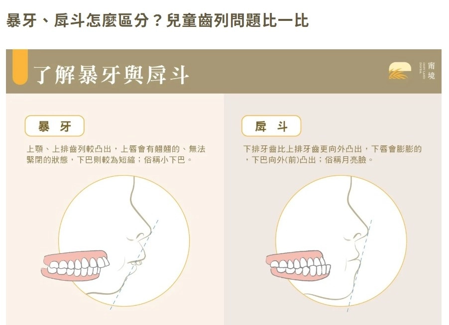 兒童牙齒必須矯正的暴牙、戽斗狀況圖