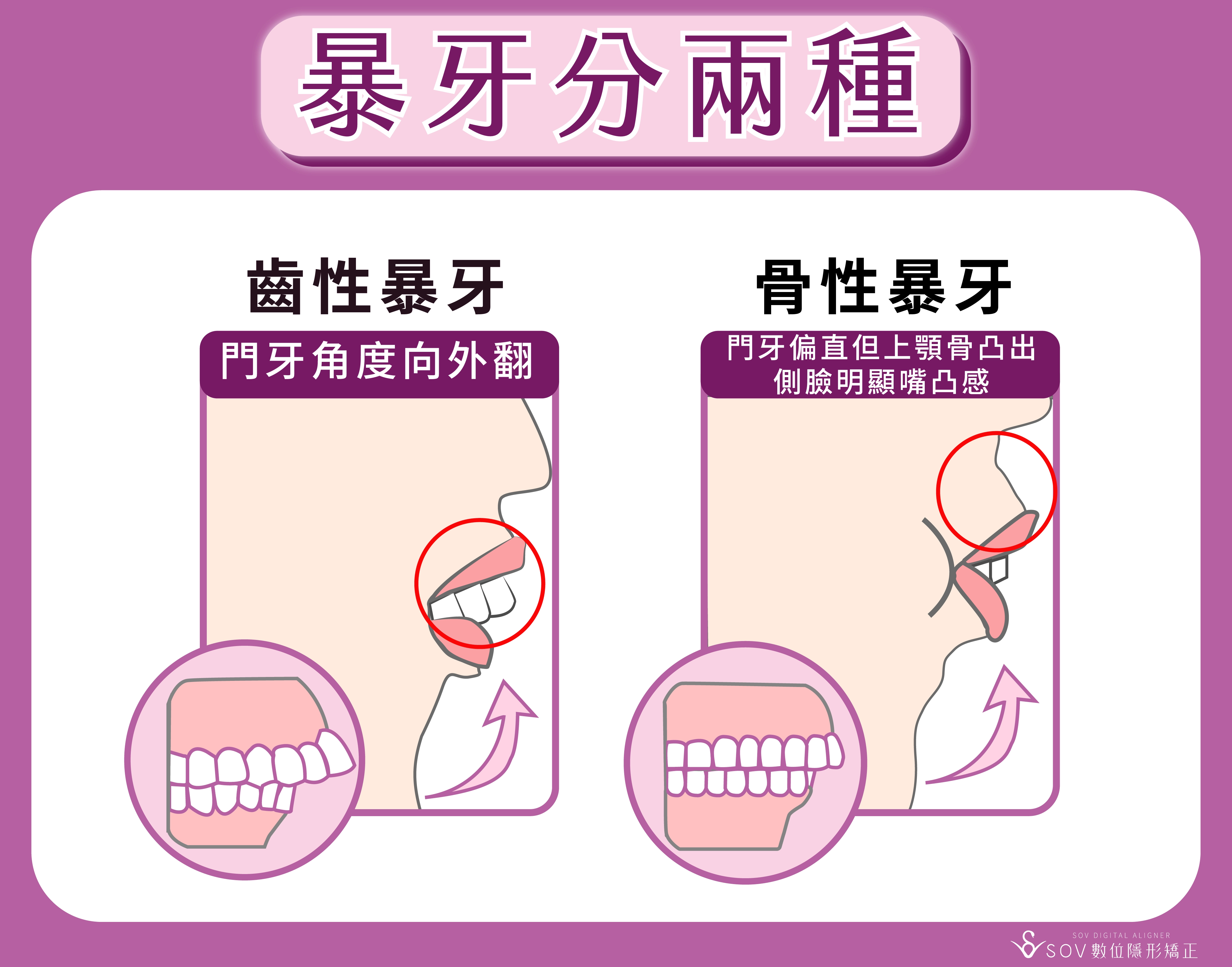 暴牙分兩種
