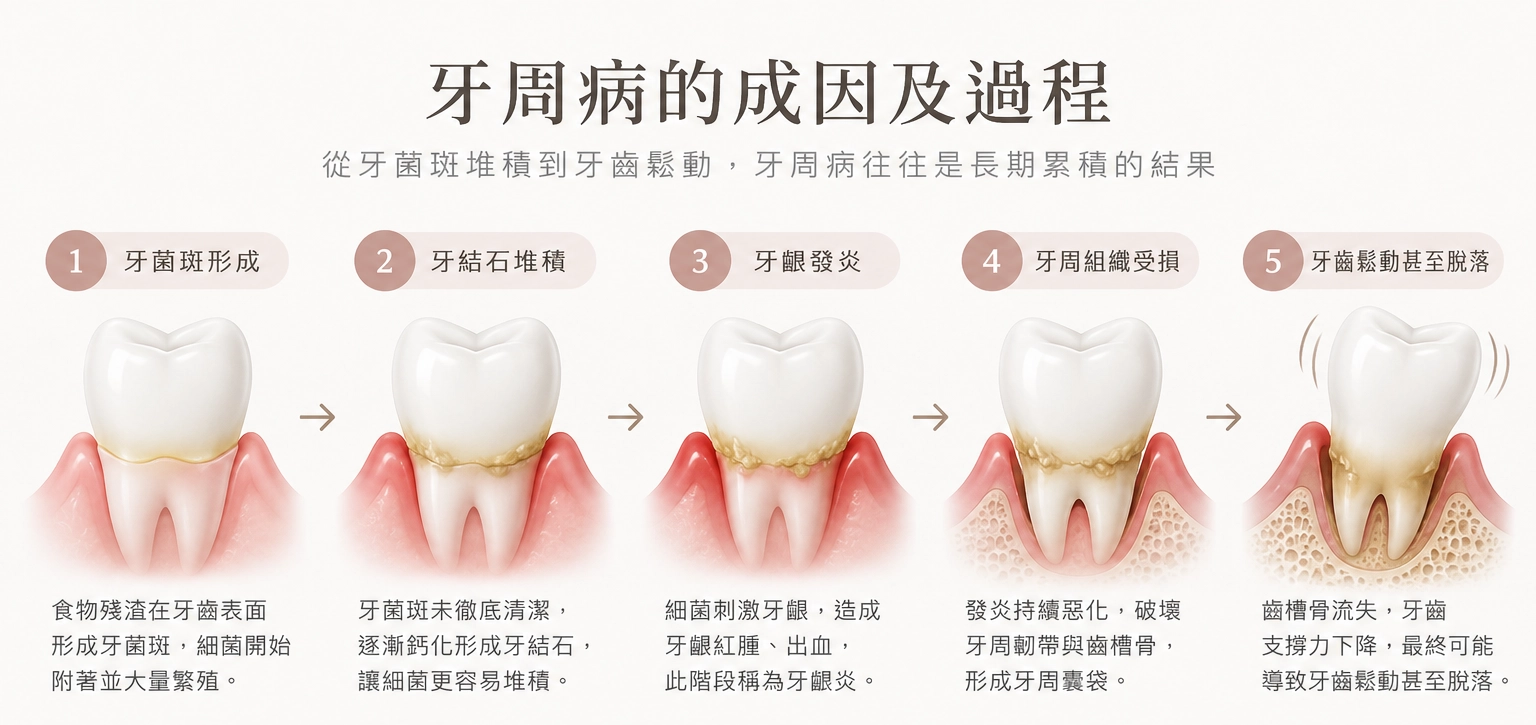 牙周病成因及過程/德林牙醫