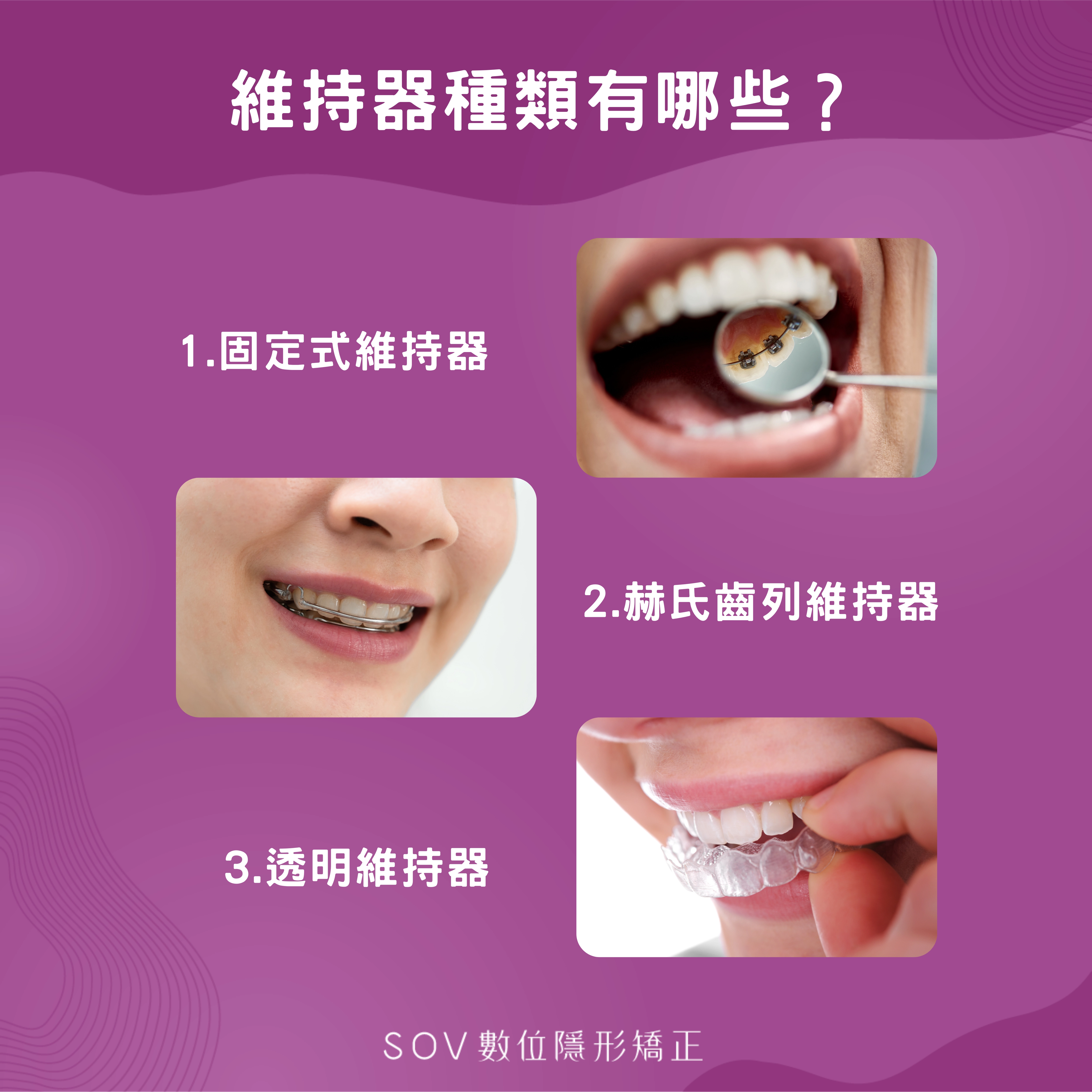 三款牙齒維持器的照片